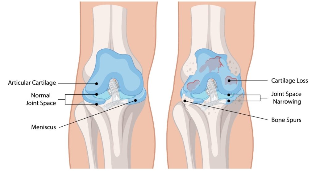 Η διαφορά μεταξύ φυσιοθεραπείας και εργοθεραπείας. Η εικόνα δείχνει σε γραφικό μια περίπτωση οστεοαρθρίτιδας (freepik.com)